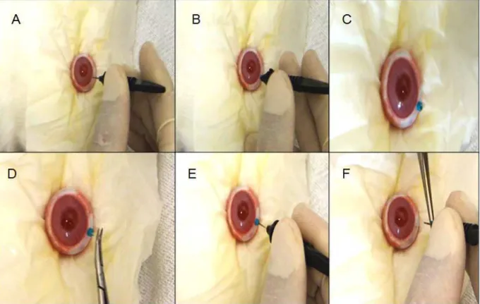 Figura 2.1 – Etapas da cirurgia de inserção dos implantes. (A) introdução do trocarter; (B) término  da  introdução  do  trocarter;  (C)  trocarter  inserido  trans-esclera;  (D)  inserção  do  implante;  (E)  inserção do implante através da esclerotomia; 