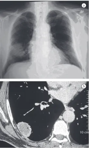 Figure 1 - In a), anteroposterior chest X-ray showing  a  peripheral  nodular  opacity  in  the  right  middle/