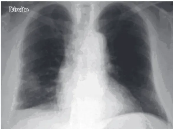 Figure  3  -  Anteroposterior  chest  X-ray  showing  improvement in the peripheral nodular opacity in the  right lung.