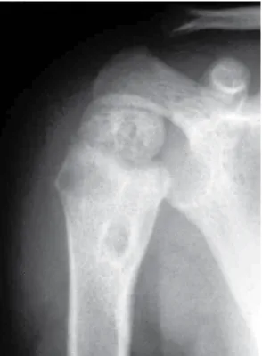 Figure 1 - X-ray of the proximal humerus revealing  osteolytic  lesions  with  peripheral  sclerosis  in  the  humeral epiphysis/metaphysis.