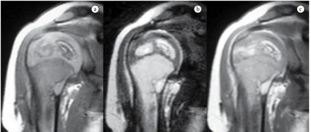 Figure 2 - Magnetic resonance imaging of the humerus, in a T1-weighted sequence (a) and a T2-weighted  sequence (b), as well as a T1-weighted sequence after the injection of a gadolinium contrast agent (c)