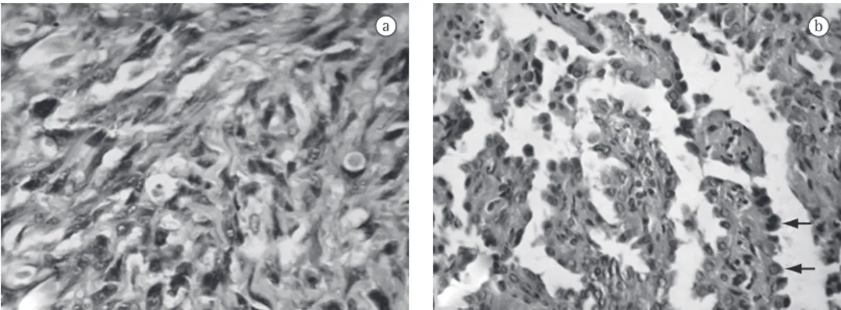 Figure  2  - In a), high-grade spindle-cell sarcoma. We observe severe nuclear atypia