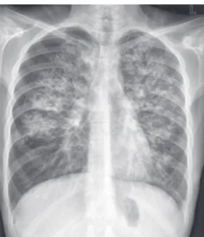 Figure 1 - Chest X-ray showing bilateral pneumothorax  and  bilateral  interstitial  infiltration  caused  by  cystic  fibrosis