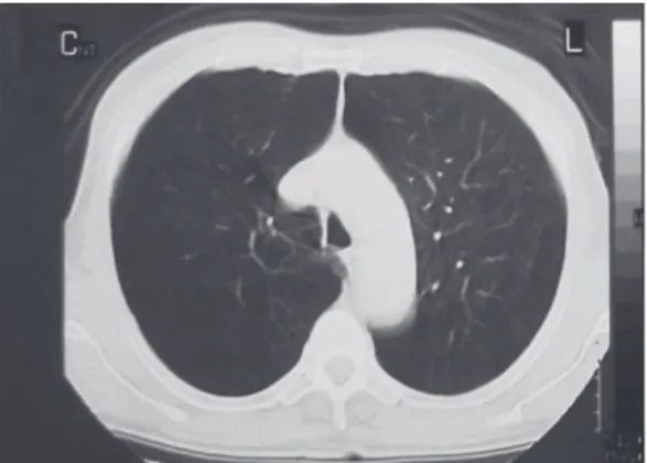 Figure  1  -  Tomographic  view  (patient  2)  showing  lung hyperinflation and severe diffuse emphysema.