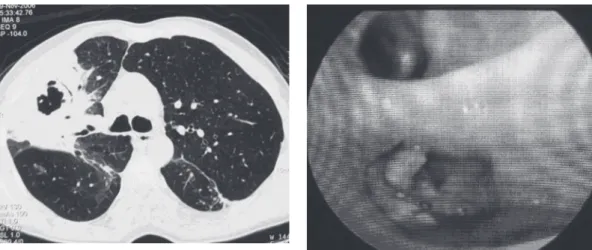 Figure  2  -  Fiberoptic  bronchoscopy  demonstrating  exophytic lesion in the left lower lobe upper segment,  the  histopathological  examination  of  which  was  consistent with aspergillosis.