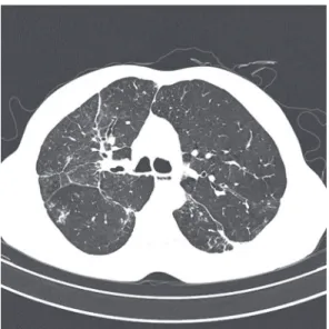 Figure  3  -  High-resolution  computed  tomography  scan,  performed  as  a  control  in  December  of  2007,  showing  total  regression  of  the  consolidation  with  cavitation in the right upper lobe.
