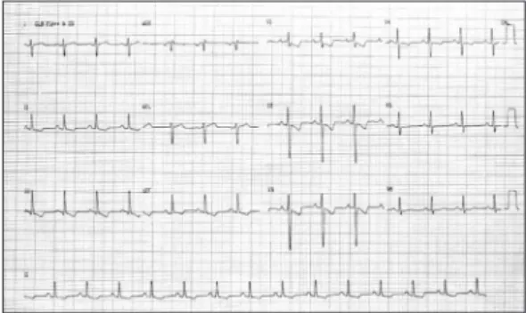 Figure 1 - Electrocardiogram of a 24-year-old patient  with idiopathic pulmonary arterial hypertension