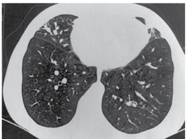 Figure  1  -  Chest  CT  scan  showing  opacities  in  the  middle  lobe  and  in  the  inferior  segment  of  the  lingula.