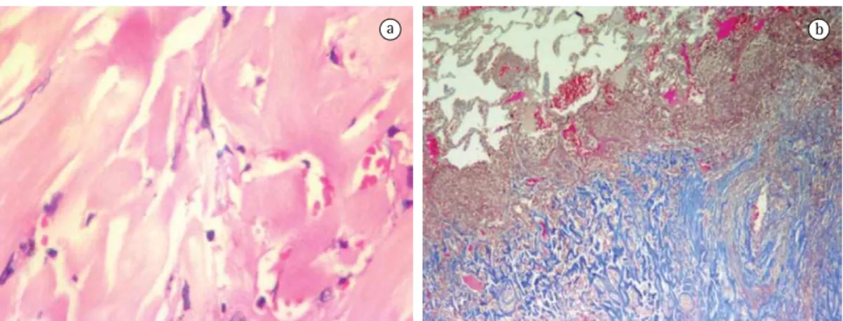 Figure 3 - Histological sections. In a), central area of the keloid-like paucicellular lesion, composed of collagen  (H&amp;E; magnification, ×400)