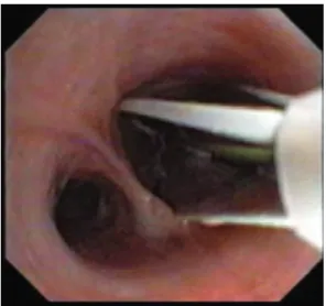 Figure 4 - Continuous activation with the catheter in the airway. In A, basket catheter inserted distally into the  airway: electrodes expanded and generator activated; in B, electrodes partially collapsed and retracted 5 mm  distal to the previous activat