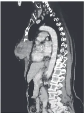 Figure 1 - Chest CT revealing an inflated, eccentric lytic  lesion of the sternum, measuring 12 × 7.5 × 4.5 cm,  with thinning or erosion of the cortical bone.