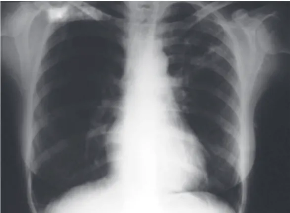 Figure  2  -  Chest  X-ray  revealing  alveolar  opacities  in  the  left  upper  lobe  and  bilaterally  at  the  lung  bases, as well as images suggestive of bronchogenic  dissemination  in  the  middle  third  of  the  left  hemithorax.