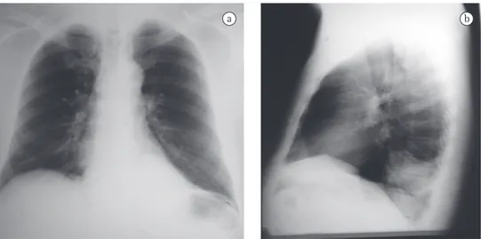 Figure 1 - Anteroposterior chest X-ray (in a) and lateral chest X-ray (in b). Area of opacity behind the cardiac  silhouette, on the left, projected over the spinal column and not bordering the left diaphragm