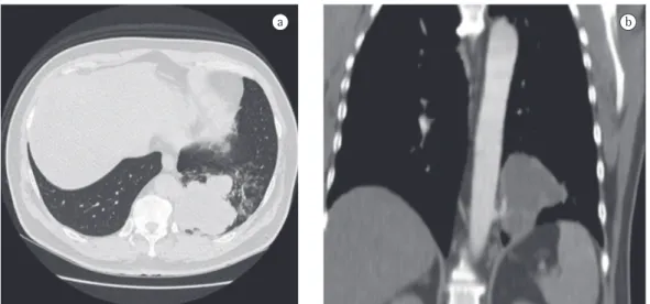 Figure 2 - Chest CT scan. In the lung window (in a), there is an area of lobulated opacity in the posterior  segment of the left lower lobe