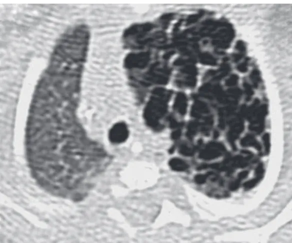 Figure  20  -  Interstitial  emphysema  in  an  adult  patient,  characterized  by  rounded  areas  (arrow)  and  bands distributed along the interlobular septa (arrow  heads) with air density.