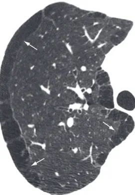 Figure 23 - Interlobular septal thickening (arrows) of  the smooth type in a patient with pulmonary edema