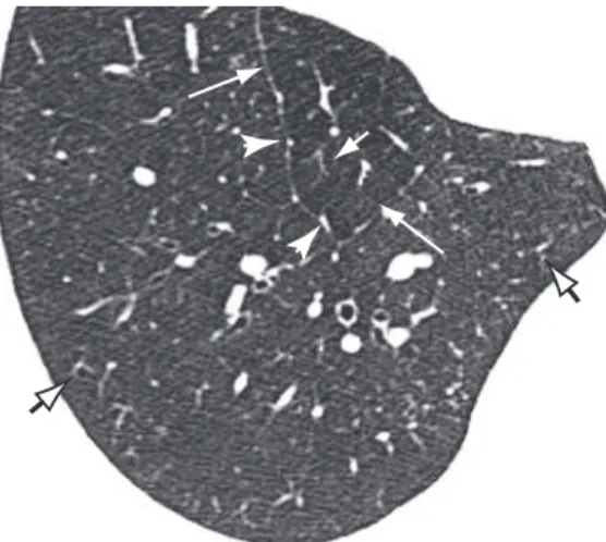 Figure 25 - Axial HRCT scan of the chest in a normal  patient,  revealing  interlobular  septa  (long  arrow)  delineating  the  pulmonary  lobule  and  centrilobular  structures corresponding to the intralobular arteries,  identified  as  small  branched 