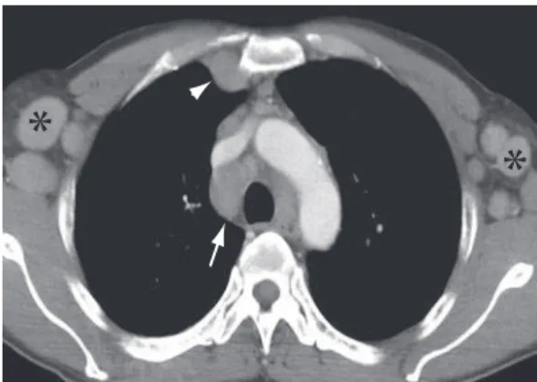 Figure 31 - Axial CT slice of the chest with iodinated  contrast  material  revealing  enlarged  mediastinal  lymph  nodes  (arrow),  chest  wall  lymph  node  enlargement (arrow head) and bilateral axillary lymph  node enlargement (asterisks).