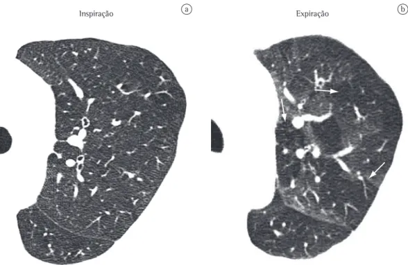 Figure 1 - Axial HRCT scan of the chest during inhalation (a), revealing no significant changes