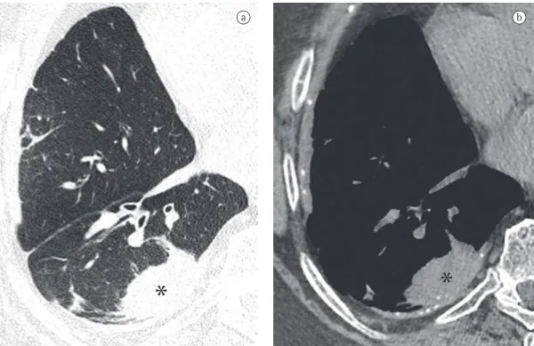 Figure 7 - Axial CT slice of the chest obtained with  the patient in the prone position revealing a fungus  ball  with  air  crescent  sign  in  residual  tuberculous  cavity