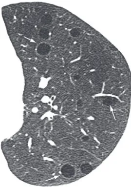 Figure  16  -  Pulmonary  cysts  (arrows)  in  a  patient  with lymphangioleiomyomatosis.