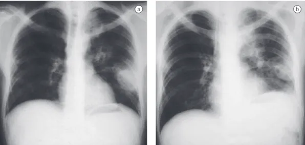 Figure 1 - Chest X-ray of a patient with leukemia showing cavitation (in a) and pulmonary consolidation (in  b) by  Rhizomucor pusillus .