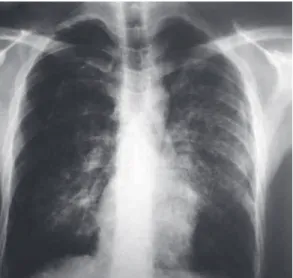 Figure 1 - Chest X-ray revealing diffuse, heterogeneous  opacities  and  bilateral  pneumothorax