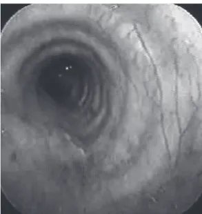 Figure 2 - Complete opening of the bronchial lumen  after excision of the tumor.