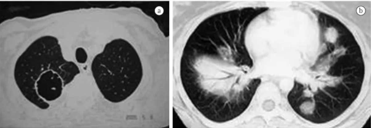 Figure 2 - In a, CT scan showing a cavitary lung mass in a patient with Wegener’s granulomatosis