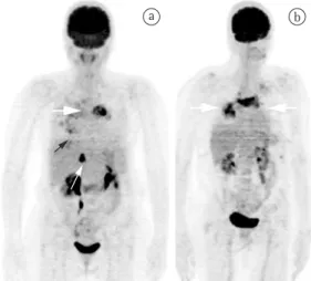 Figure 2 - In a, 18F-fluorodeoxyglucose positron  emission tomography of Case 1 showing increased  radiotracer uptake in the region corresponding to  that of the pulmonary artery (thick white arrow)