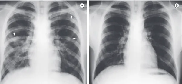 Figura 1 - Radiografia do tórax em incidência posteroanterior. Em a, nódulos bilaterais no parênquima  pulmonar (setas)