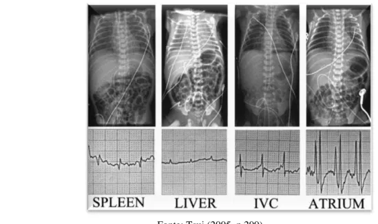 Figura 8  – Traçado eletrocardiográfico e correspondente radiografia com CVU posicionado ao nível do  baço, fígado, VCI e átrio 