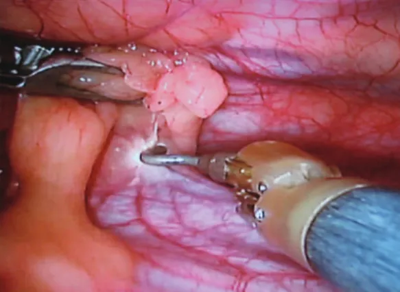 Figure 2 - Thymus dissection at the left cardiophrenic  angle.