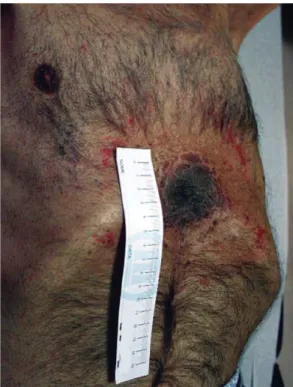 Figure 3 - Final appearance of the lesion three  weeks after radiation therapy and the first cycle of  pemetrexed.