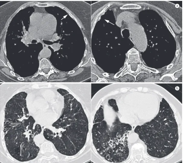 Figure 1 - In a, CT scan of the chest (mediastinal window) showing bilateral pleural plaques, some of which  are calcified (arrows)