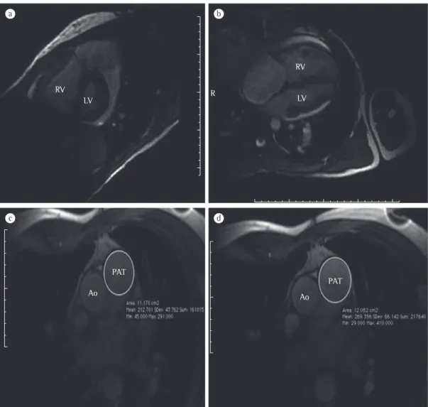 Figure 7 - Magnetic resonance images of a 35-year-old male patient with idiopathic pulmonary arterial  hypertension