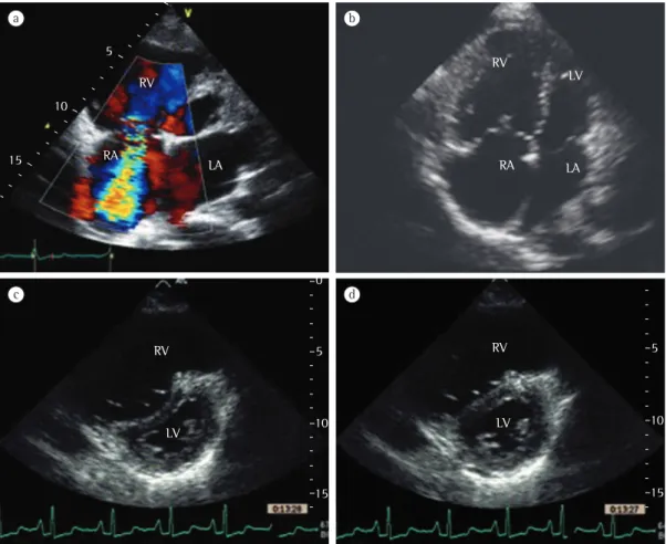 Figure 3 - Echocardiography images. Note the intensity of the continuous wave Doppler signal of the tricuspid  regurgitant jet during ventricular systole (in a) and the dilated right heart (in b)