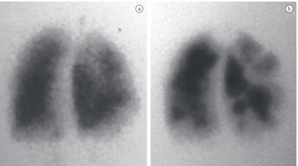 Figure 4 - Ventilation/perfusion lung scintigraphy images of a 59-year-old male patient undergoing etiological  investigation of pulmonary hypertension and with normal findings on CT angiography of the pulmonary  arteries