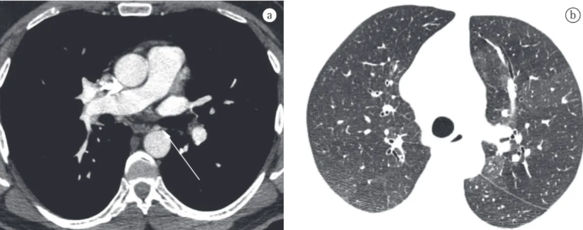 Figure 5 - CT angiography image (in a) and HRCT image (in b) of a male patient with thrombotic pulmonary  hypertension