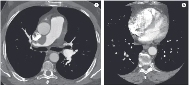 Figure 6 - CT angiography images of patients with chronic thromboembolism (in a) and acute thromboembolism  (in b)