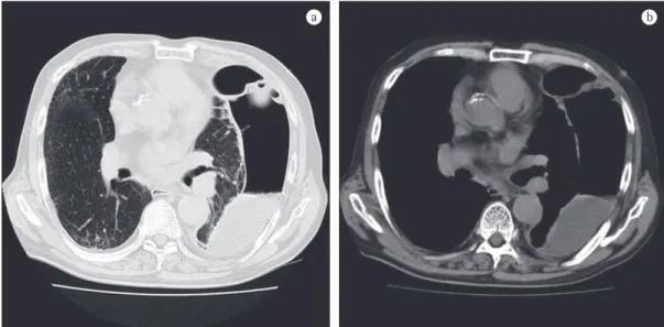 Figure 2 - Chest CT at admission, lung and mediastinal window settings (a and b) showing a fluid-filled bulla,  measuring 4.5 × 17 × 24 cm, in the left lung.