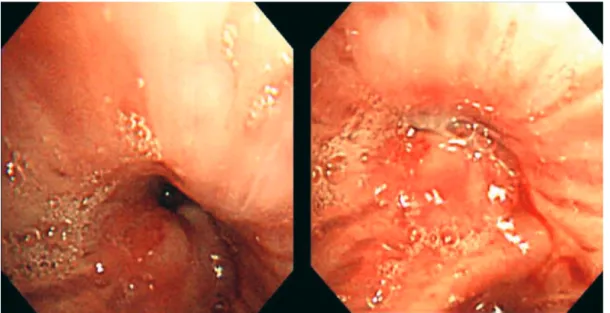 Figure 3 - Bronchoscopic view of an obstruction (tumor) in the left lower bronchus.