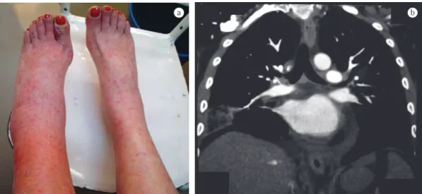 Figura 1 - Em a, fotografia mostrando edema de perna esquerda e púrpura palpável em ambas as pernas