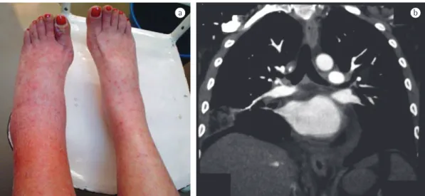 Figure 1 - In a), a photograph showing left-leg edema and palpable purpura on both legs