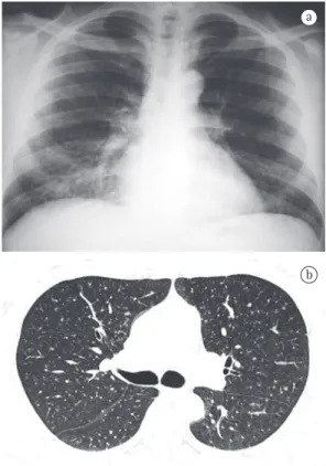 Figura 1 - Em a, radiografia do tórax em incidência  póstero-anterior demonstrando tênue infiltrado  intersticial difuso, do tipo micronodular, predominando  nas bases pulmonares