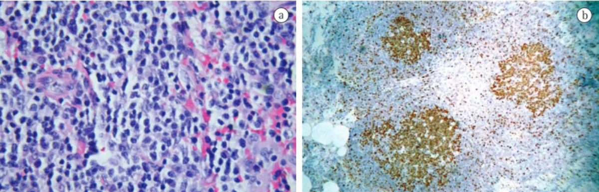 Figura 2 - Histopatologia. Em a, fragmento do pulmão demonstrando lesão linfoepitelial caracterizada por  pequenos linfócitos distribuídos pelo parênquima pulmonar (H &amp; E; aumento, 40×)