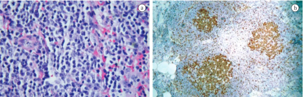 Figure 2 - Histopathology. In a, lung fragment showing lymphoepithelial lesion characterized by small  lymphocytes distributed throughout the lung parenchyma (H &amp; E; magnification, ×40)
