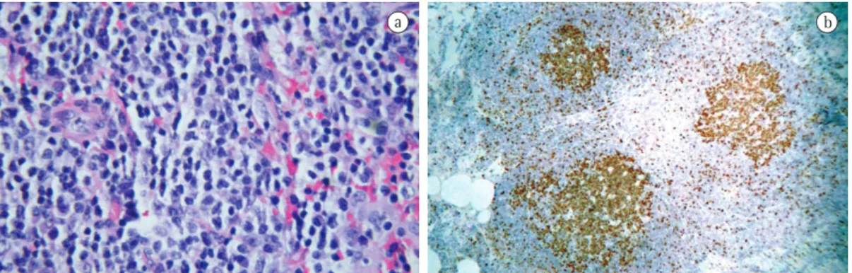 Figure 2 - Histopathology. In a, lung fragment showing lymphoepithelial lesion characterized by small  lymphocytes distributed throughout the lung parenchyma (H &amp; E; magnification, ×40)