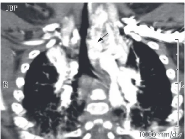 Figure 2 - Evaluation of the larynx and trachea by means of rigid bronchoscopy. In a, a large vascularized  mass obstructs approximately 80% of the tracheal lumen
