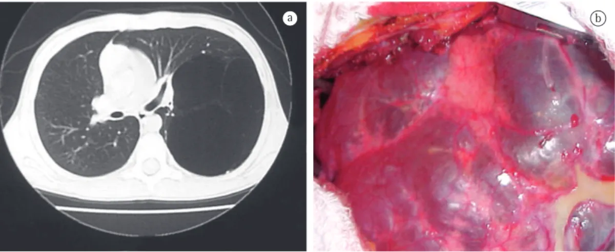 Figure 3 - Type I cystic adenomatoid malformation. In a, CT scan of the chest showing a lesion with large cysts  in the left lower lobe